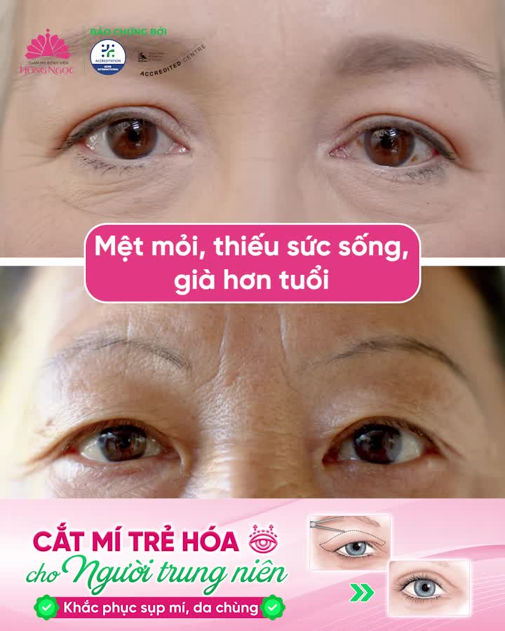 MẮT SỤP MÍ, DA MÍ CHÙNG XỆ KHIẾN GƯƠNG MẶT GIÀ HƠN TUỔI?