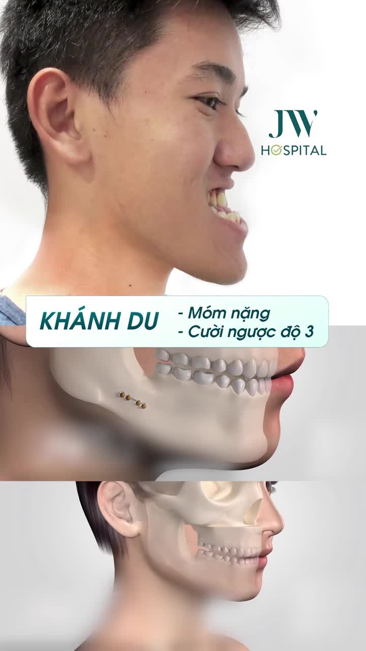 TOP 5 CA PHẪU THUẬT HÀM "THAY SẮC ĐỔI VẬN" GÂY BÃO TẠI JW – CƠ HỘI HỖ TRỢ ĐẾN 100% CHI PHÍ!