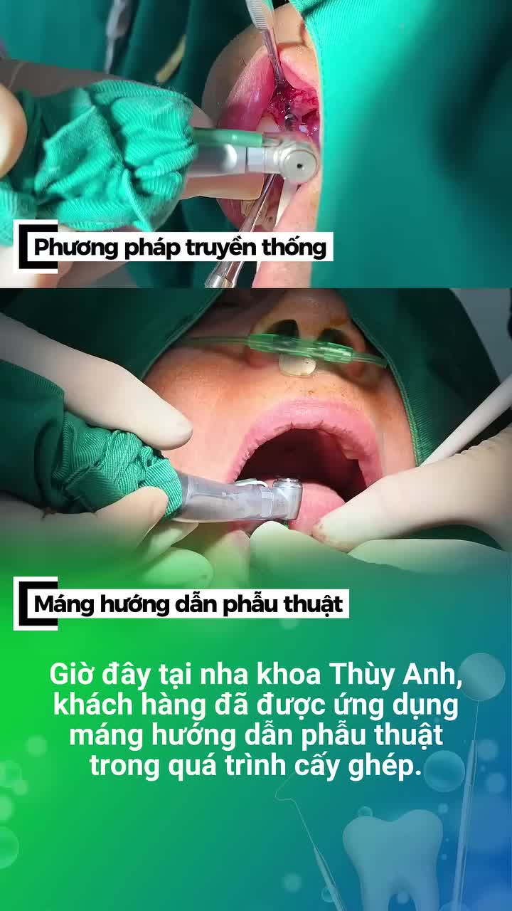 PHƯƠNG PHÁP CẤY GHÉP IMPLANT HIỆN ĐẠI ĐANG ĐƯỢC NHIỀU KHÁCH HÀNG QUAN TÂM!