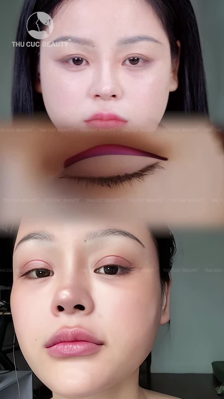 Chỉ 15P thực hiện Cắt mí - Nhận đôi mắt cực ưng ý!!!