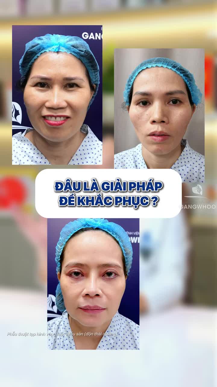 Độn thái dương có giúp gò má bớt cao không, cùng xem video này nhé!