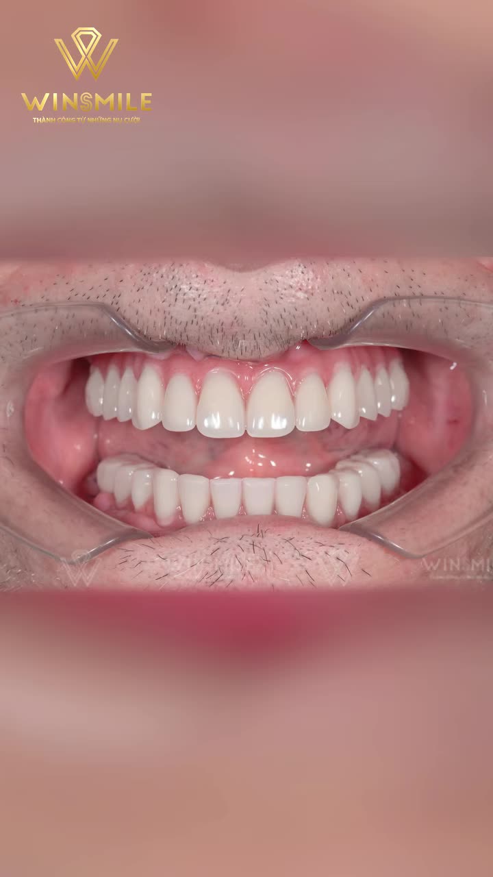 Vượt hàng nghìn cây số từ Úc đến Việt Nam, ông Frank Capolongo (1958) đã lựa chọn Win Smile để bắt đầu hành trình phục hồi nụ cười và khả năng ăn nhai của mình.