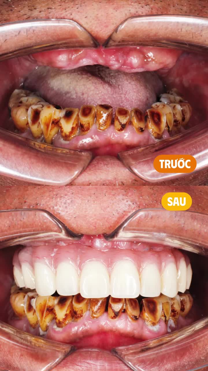 “TRẺ RA 10 TUỔI” CHỈ SAU KHI CÓ LẠI HÀM RĂNG CỐ ĐỊNH?