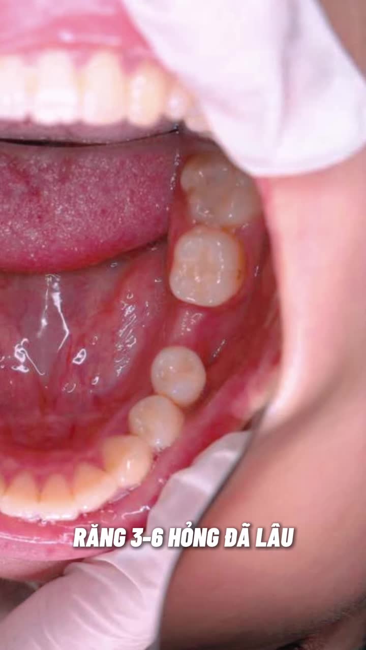 Phục hình răng 6 sớm tránh được rất nhiều hệ luỵ