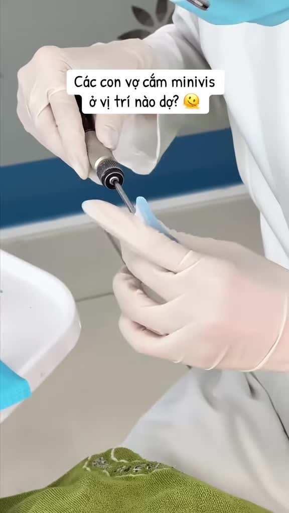 Các con vợ cắm minivis ở vị trí nào dợ?