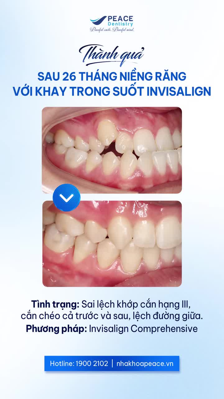 Xem thêm 42 video Niềng Răng Invisalign của bác sĩ Bs nha khoa Peace Dentistry