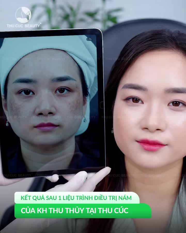 ĐÁNH BAY NỖI TỰ TI VỀ NHỮNG ĐỐM NÁM SẠM