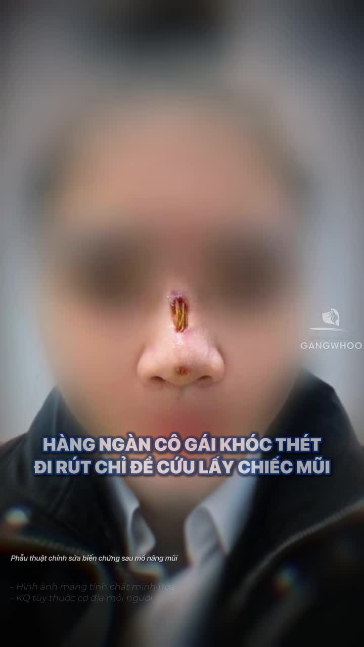 Hàng ngàn cô gái khóc thét đi rút chỉ để cứu lấy chiếc mũi của mình