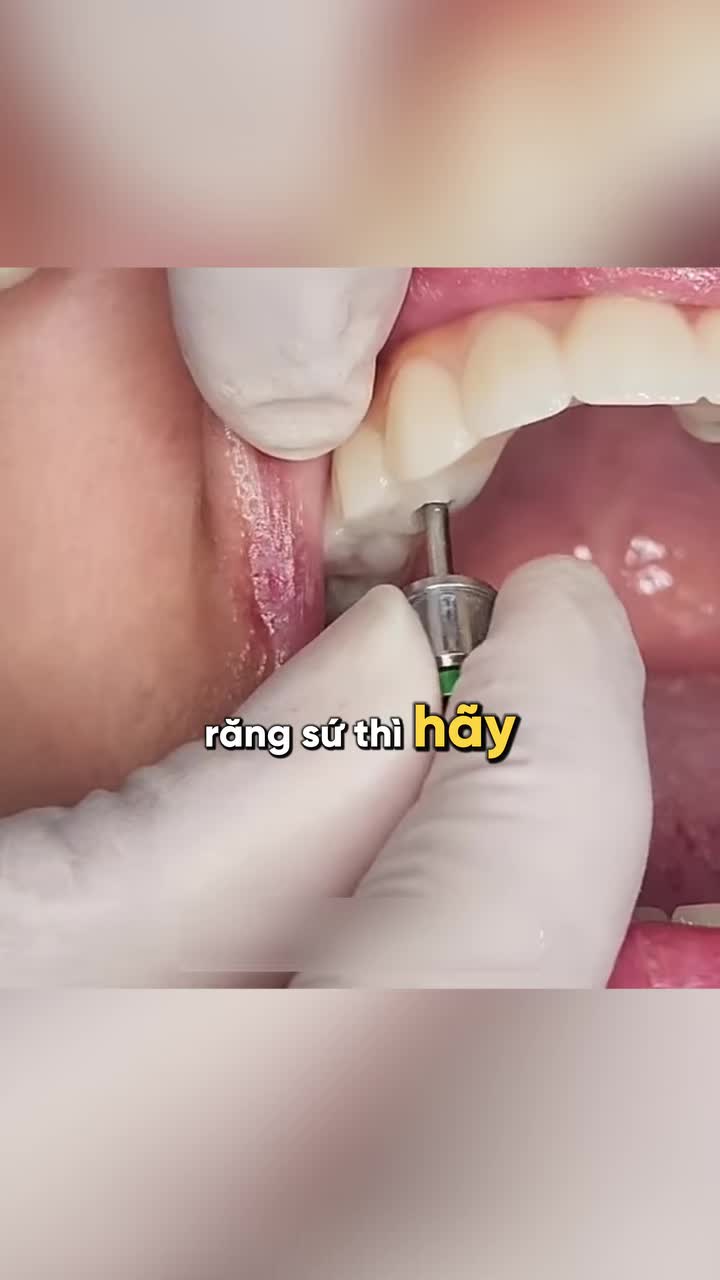 TRỒNG RĂNG IMPLANT KHÁC GÌ CẦU RĂNG SỨ?