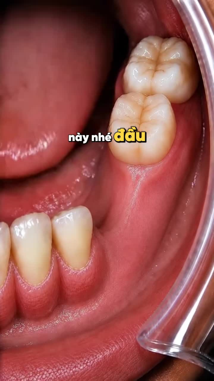CẬN CẢNH QUÁ TRÌNH CẤY RĂNG IMPLANT