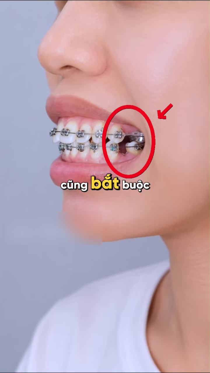 NIỀNG RĂNG CÓ BẮT BUỘC PHẢI NHỔ RĂNG KHÔNG?