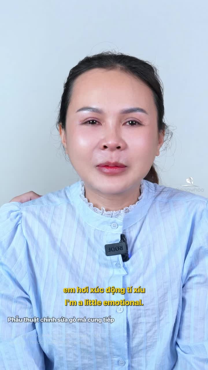 Sau 10 ngày hạ gò má có sử dụng nội soi 4K tại Bệnh viện thẩm mỹ Gangwhoo khách hàng đã xúc động với kết quả mà mình đạt được