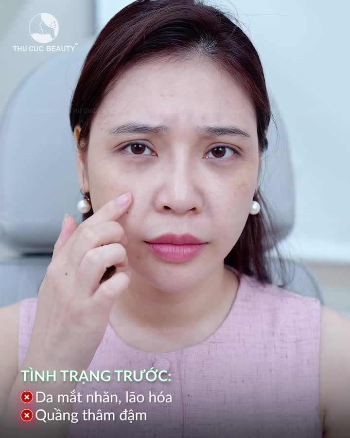 DẤU HIỆU LÃO HÓA NÀO QUANH VÙNG MẮT ĐANG KHIẾN BẠN TRÔNG GIÀ HƠN TUỔI VÀ THIẾU SỨC SỐNG?