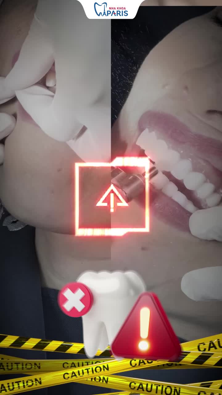 LÀM RĂNG SỨ CÓ BỊ MÀI NHIỀU RĂNG THẬT?