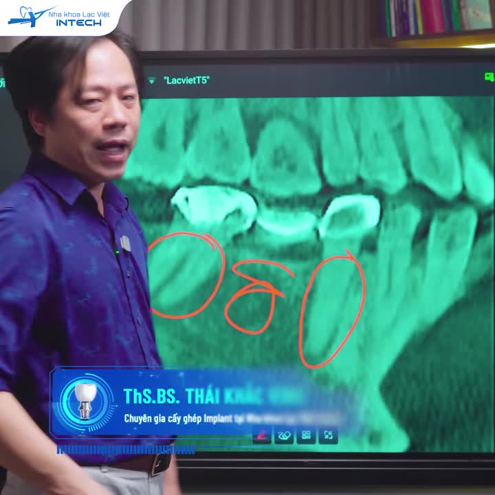 CẦU RĂNG SỨ HỎNG: KHI NÀO GIỮ ĐƯỢC? KHI NÀO CẦN THAY THẾ?