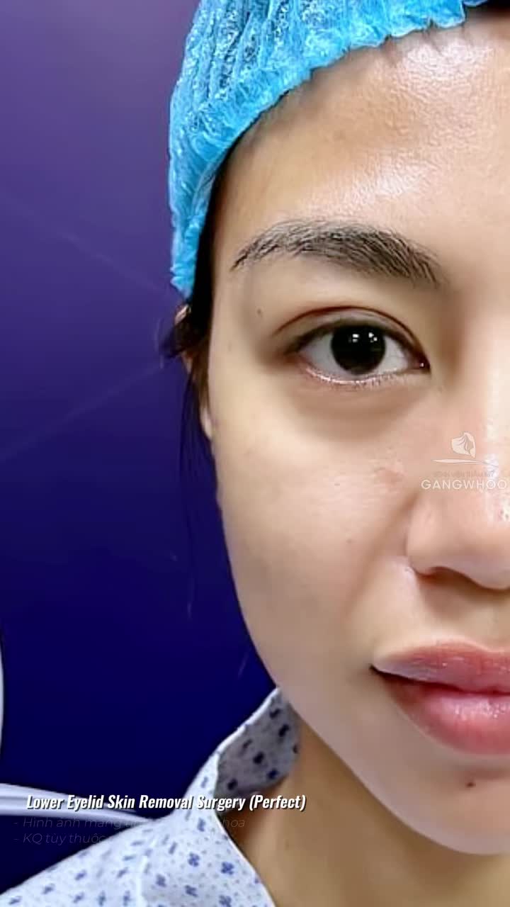 Hết bọng mỡ mắt chỉ sau 10 ngày cắt mí dưới Perfect