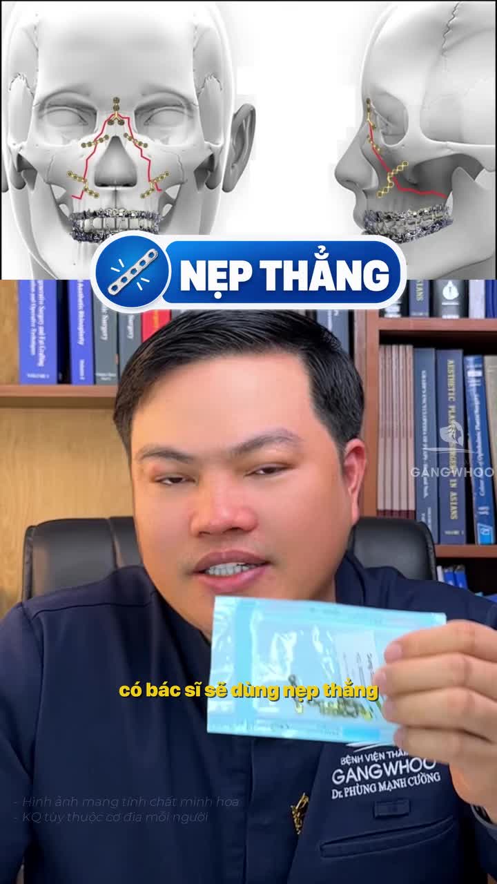 Nên dùng vật liệt nào để cố định sau hạ gò má để đem lại hiệu quả tối ưu? DMKT: Phẫu thuật chỉnh sửa gò má cung tiếp