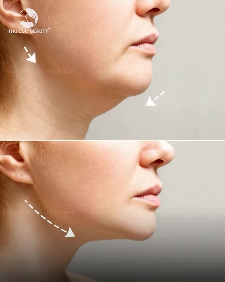 SIẾT GỌN ĐƯỜNG NÉT – SĂN CHẮC GƯƠNG MẶT CÙNG HIFU Q+