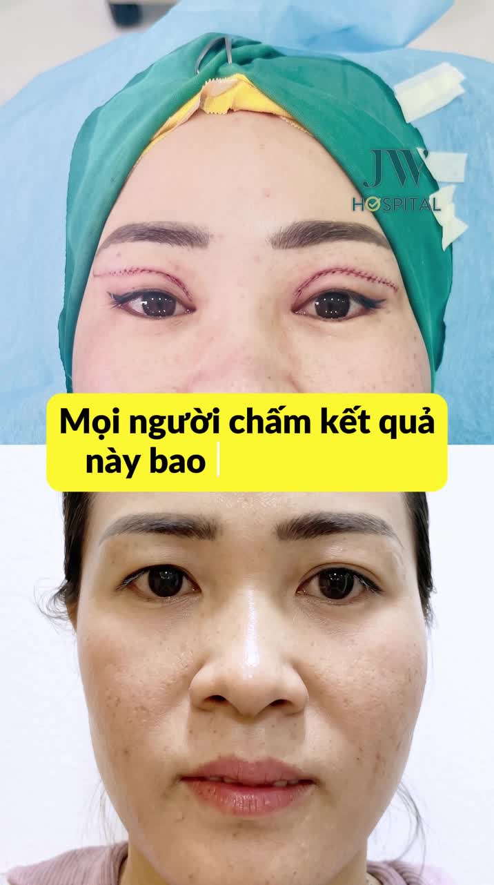 TẠM BIỆT MẮT TI HÍ, CHỊ GÁI MIỀN TÂY SỞ HỮU ĐÔI MẮT 2 MÍ TO TRÒN SAU C.Ắ.T MẮT TẠI JW