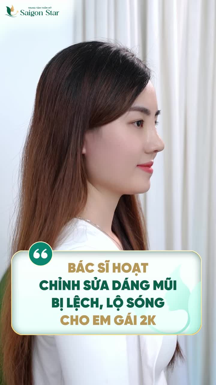 BÁC SĨ HOẠT THÀNH CÔNG GIÚP EM KHÁCH GENZ KHẮC PHỤC MŨI LỆCH - LỘ SÓNG CHỈ TRONG TÍC TẮC