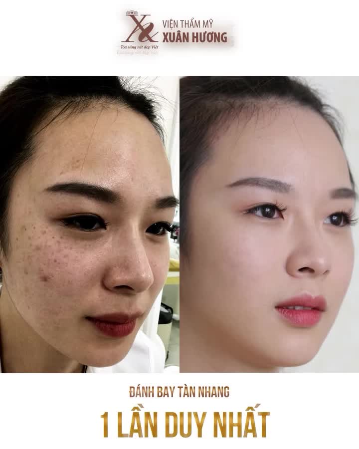 PICOSURE - ĐỈNH CAO ĐIỀU TRỊ NÁM, TÀN NHANG