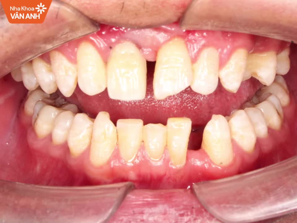 ĐÂU LÀ RĂNG THẬT, ĐÂU LÀ RĂNG GIẢ?