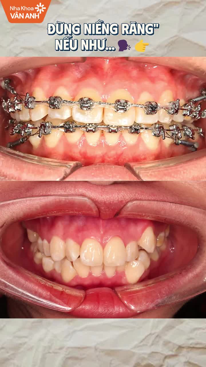 Tình trạng: Cung hàm trên hẹp, răng khấp khểnh và thiếu khoảng, một số răng mọc lệch khỏi cung hàm, kèm sai khớp cắn và lệch đường giữa.