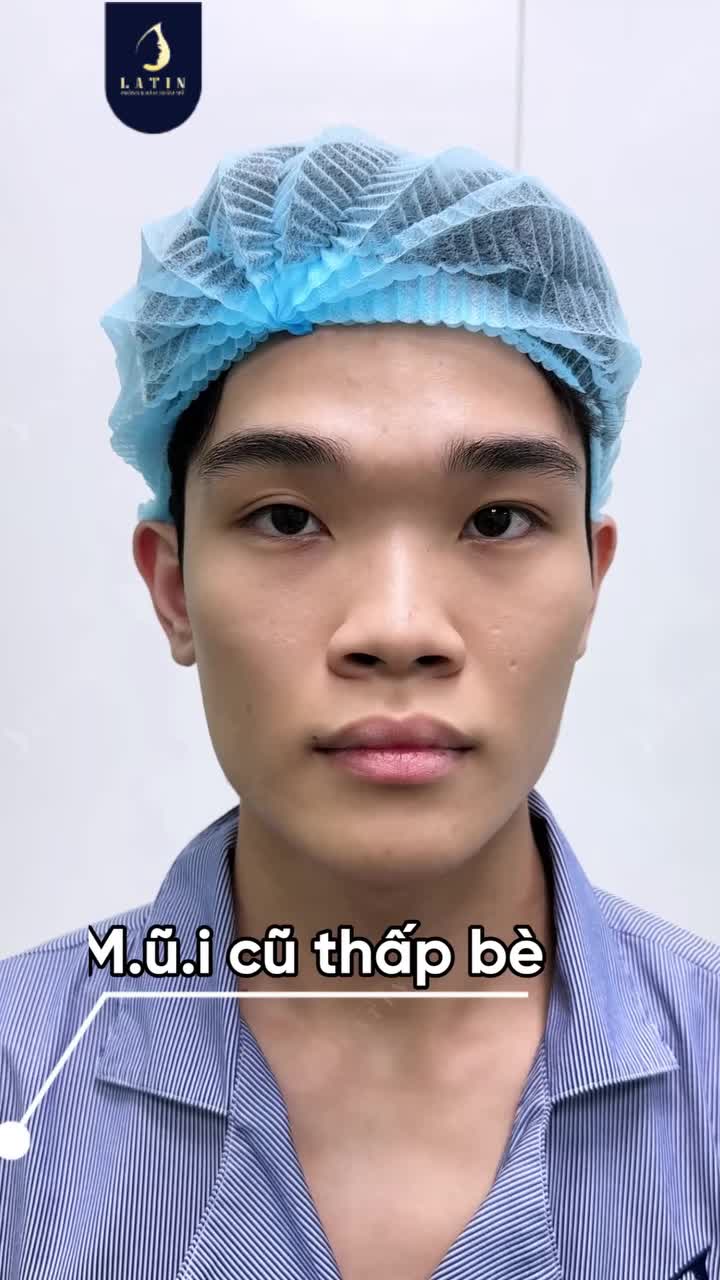 TÁI KHÁM SAU 20 NGÀY: DÁNG MŨI NAM HẾT BÈ CÓ NHƯ MONG ĐỜI?
