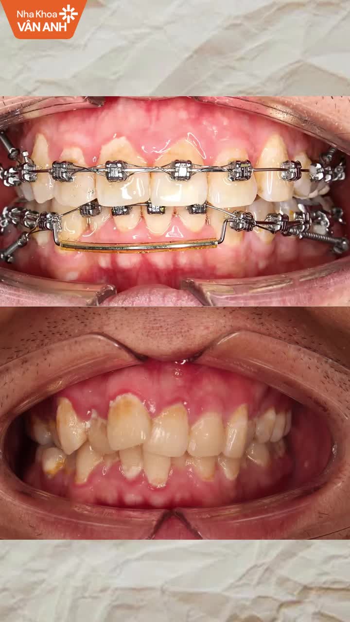 Tình trạng: Răng khấp khểnh hai hàm, cung răng chưa cân đối, có tình trạng cắn chéo, sai khớp cắn và lệch đường giữa, cần nong rộng, sắp đều răng và điều chỉnh tương quan hai hàm.