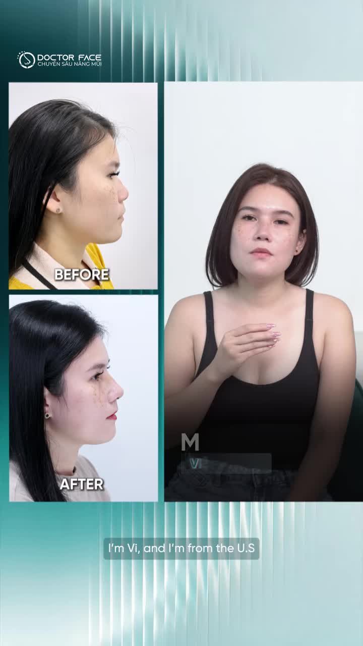 3 năm sau nâng mũi sụn sườn, chị Vi từ Mỹ trở lại Dr Face và chia sẻ một điều khiến chị rất hài lòng: đến hiện tại, nhiều người lần đầu gặp chị vẫn không nhận ra chị đã từng nâng mũi
