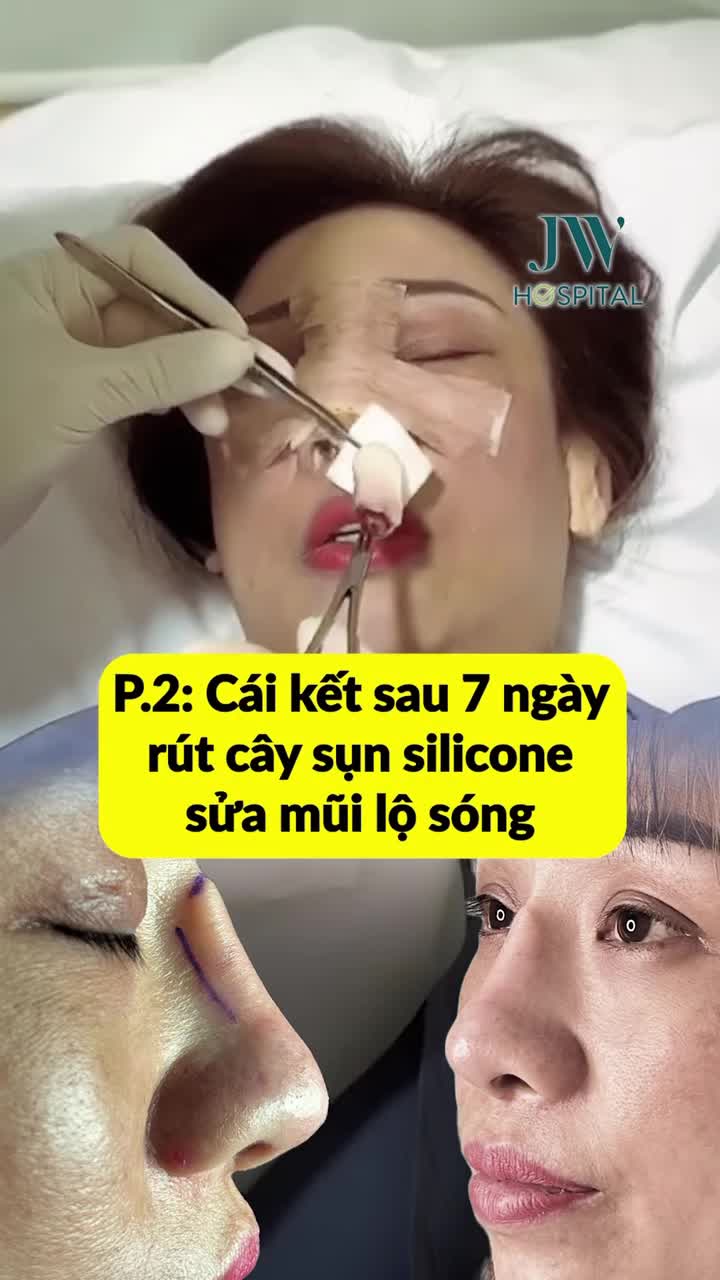 P.2: NỮ VIỆT KIỀU MẤT TRẮNG 100 TRIỆU NÂNG MŨI BỊ LỘ SỤN SILICONE - BÁC SĨ TÚ DUNG GIẢI CỨU THÀNH CÔNG SAU 7 NGÀY