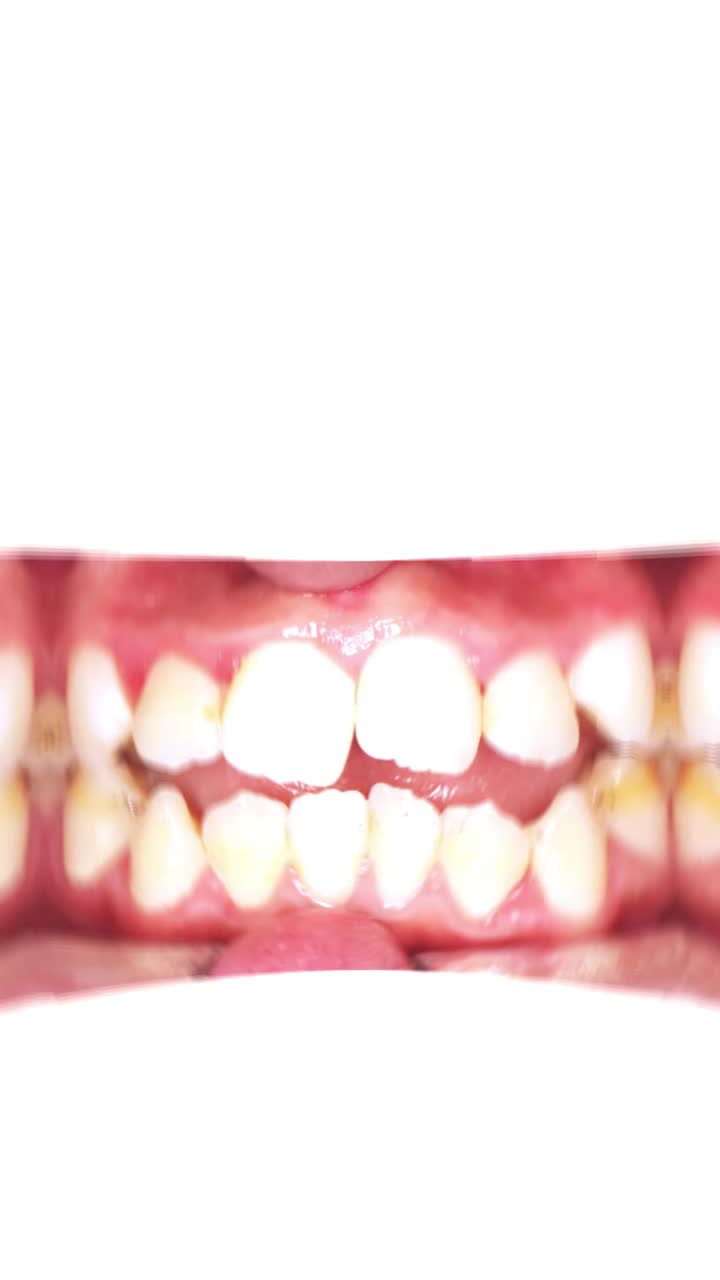 Niềng răng ở Viet Smile đã thay đổi bạn như thế nào?