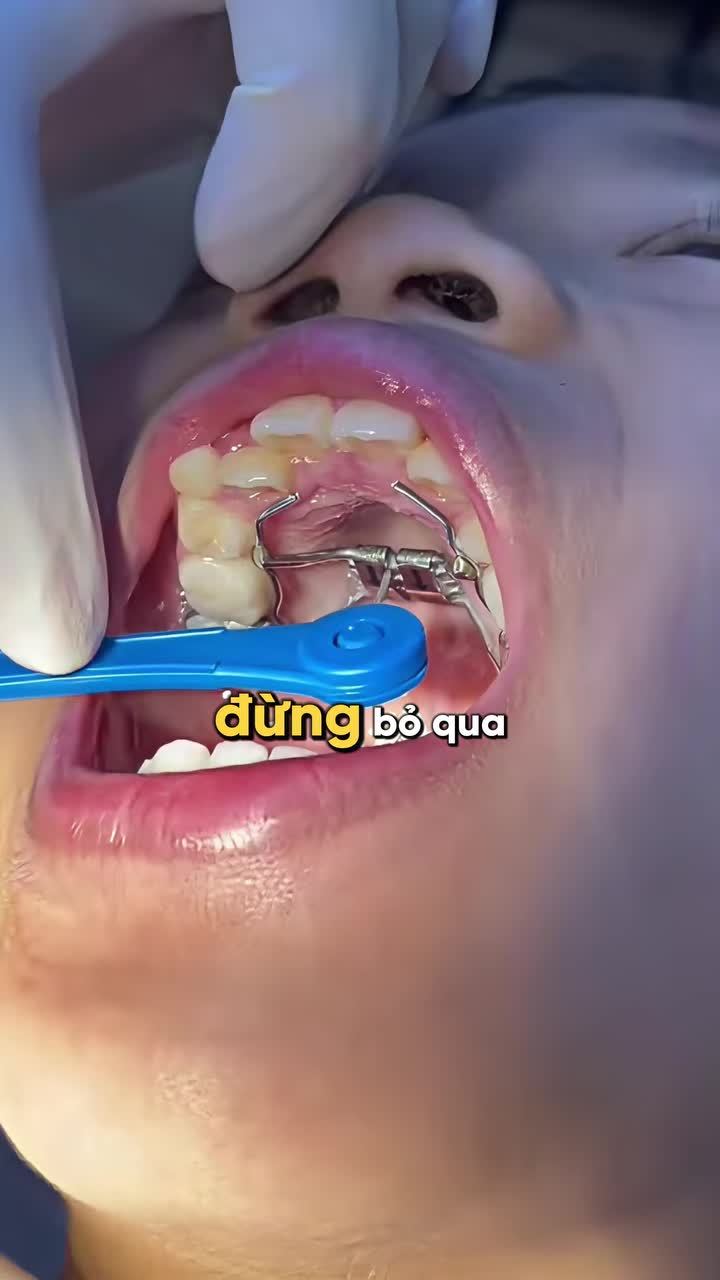 KHI NÀO NIỀNG RĂNG CẦN NONG HÀM?