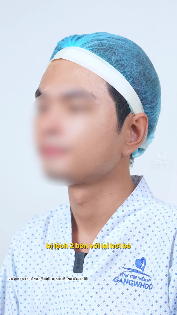 Xương hàm to 2 bên không đồng đều cùng xem quá trình Bác sĩ phân tích và thực hiện với gọt hàm có sử dụng nội soi 4K nhé!