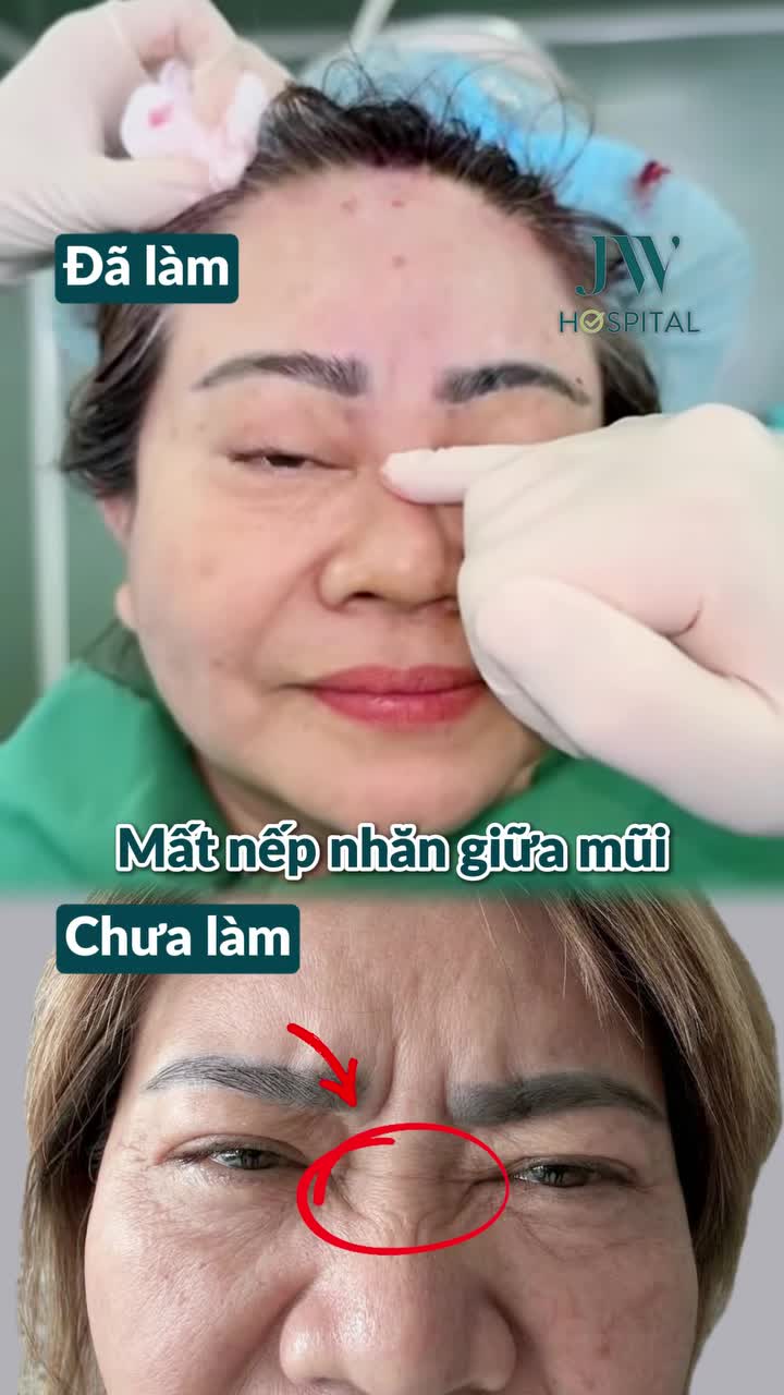 BÁC SĨ TÚ DUNG XÓA CAU MÀY, MẮT SỤP U BUỒN CHO U60 MIỀN TÂY NHỜ TREO CHÂN MÀY NỘI SOI 4X