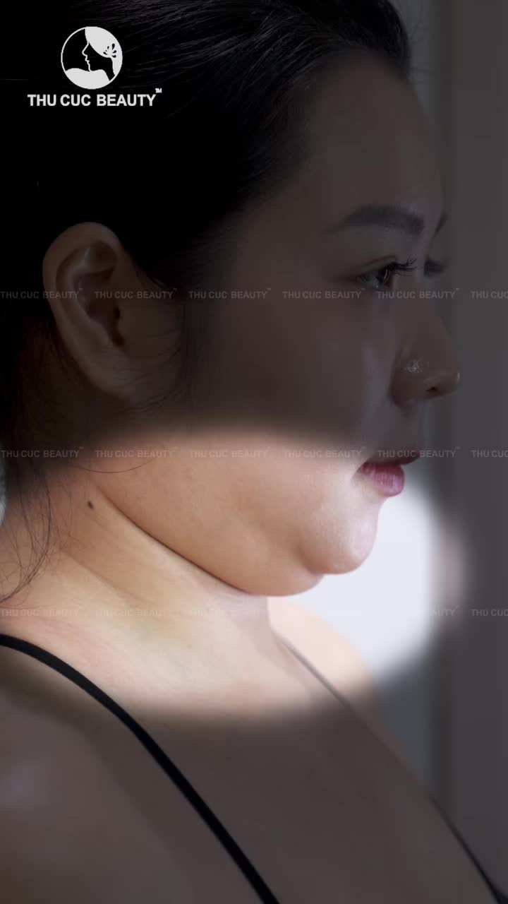 Hút mỡ nọng cằm Vaser Lipo tại Thu Cúc