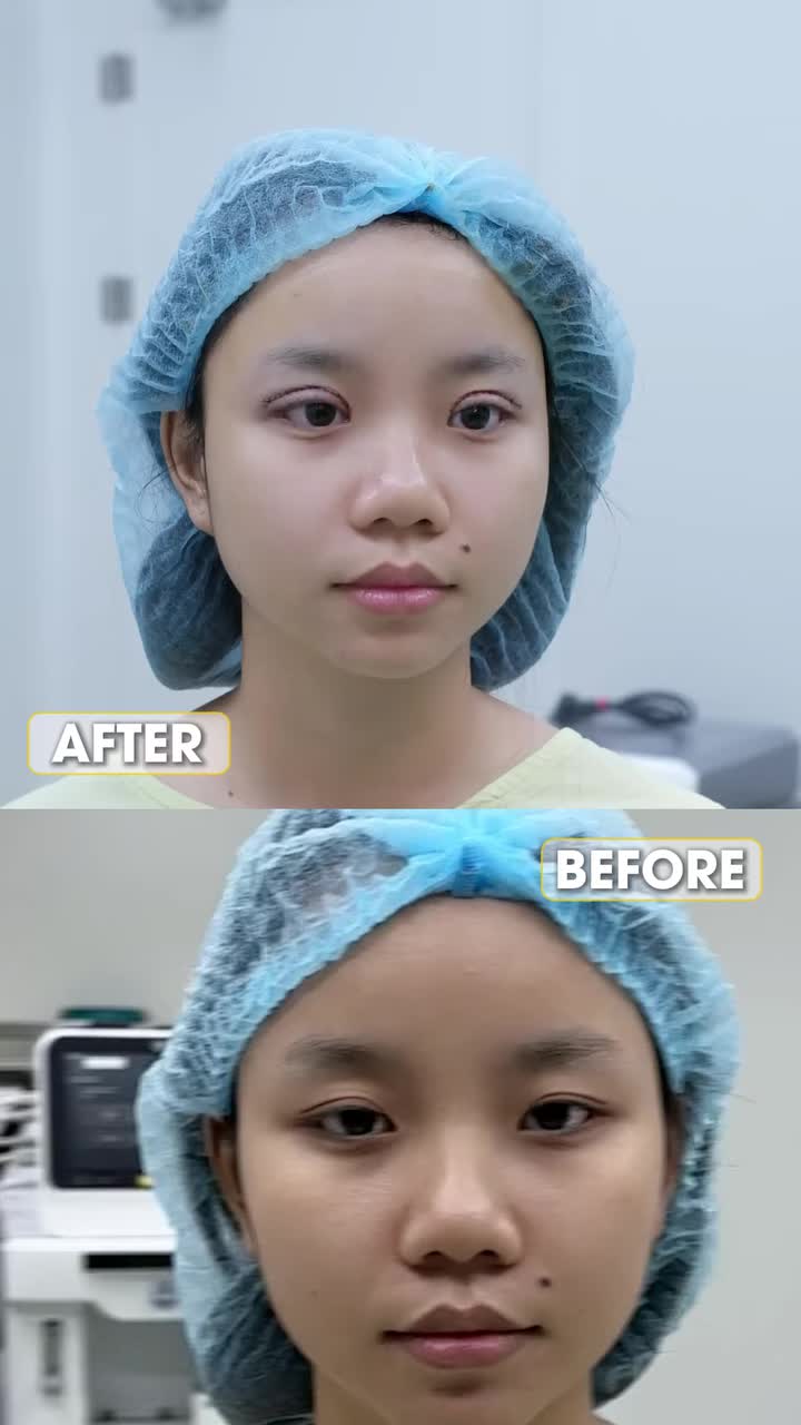 Mắt lờ đờ, kém tươi tắn, gen Z quyết định tới làm mí tại BVTM Saigon Young