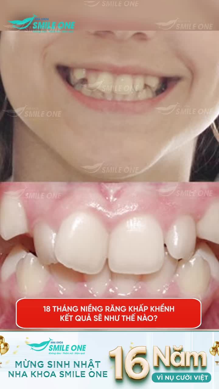 Hoài An đã thay đổi hàm răng và nụ cười như thế nào sau khi niềng răng tại Nha khoa Smile One?