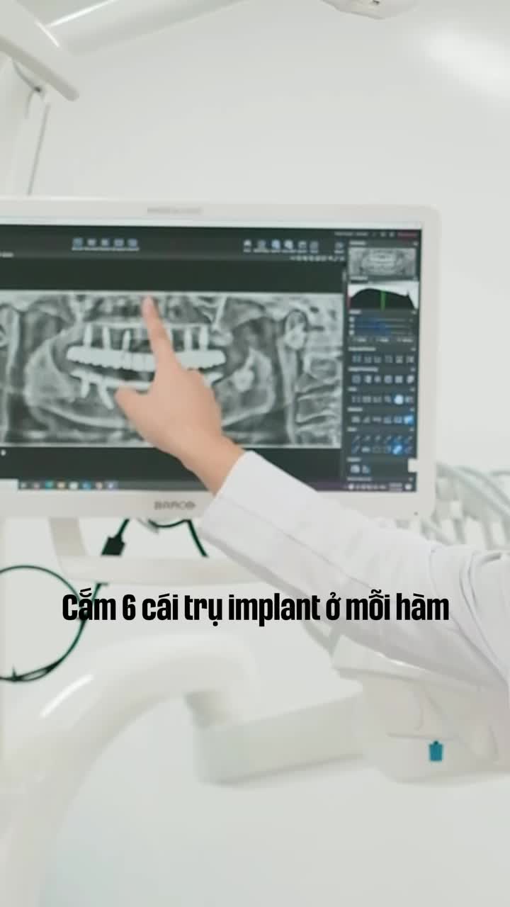 TRỒNG RĂNG IMPLANT HẾT BAO NHIÊU TIỀN?