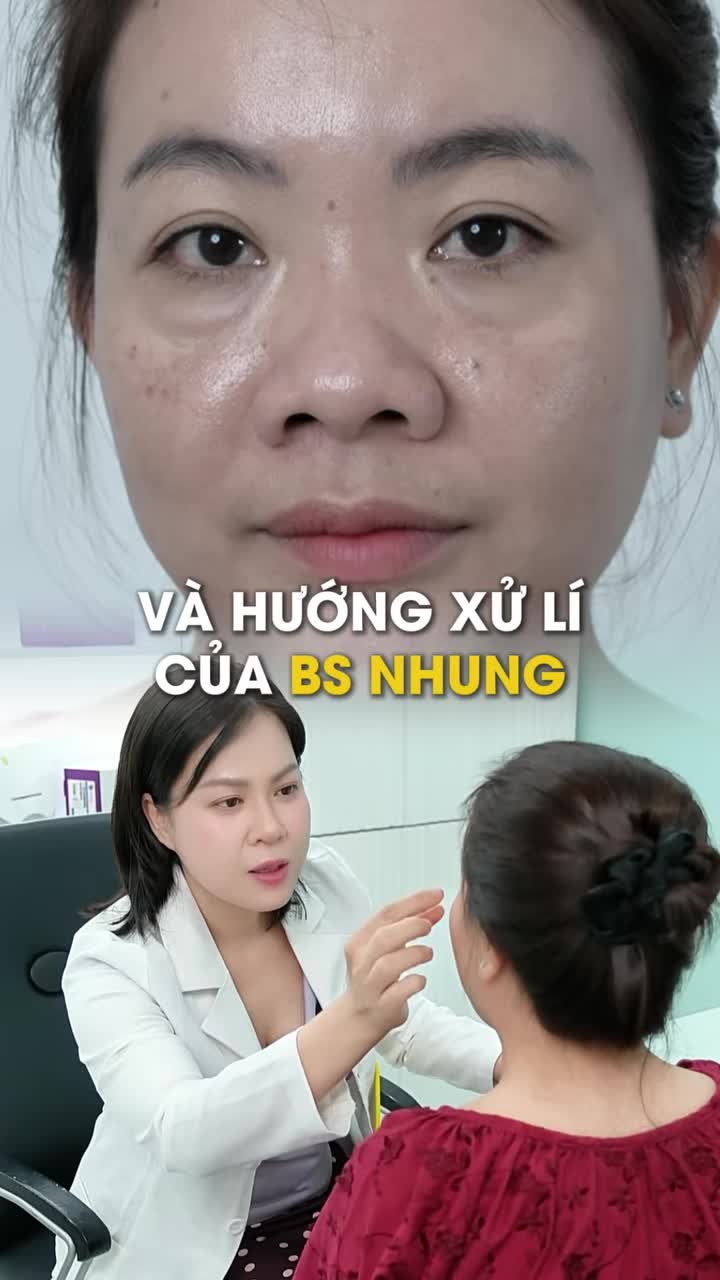 Phương pháp xử lý của BS Hồng Nhung đối với khách hàng gặp bọng mơ mí dưới phì đại và chảy x