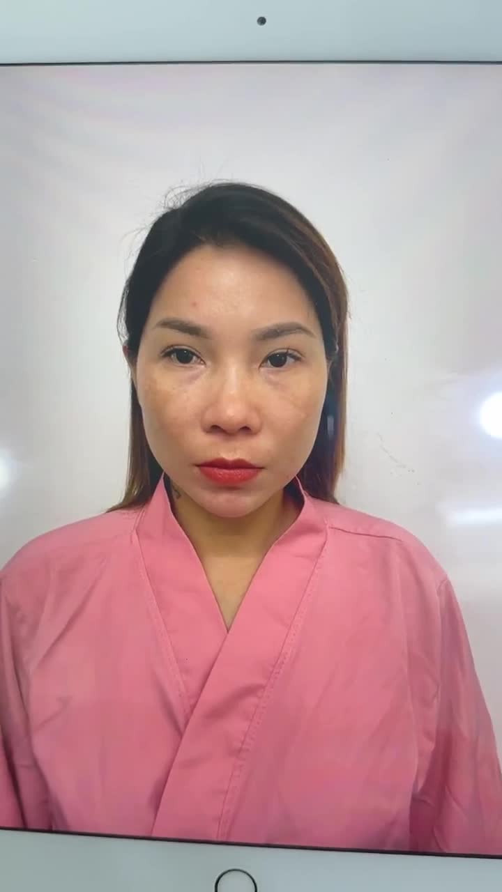 TRẢ KẾT QUẢ NÂNG MŨI NGAY SAU PHẪU THUẬT