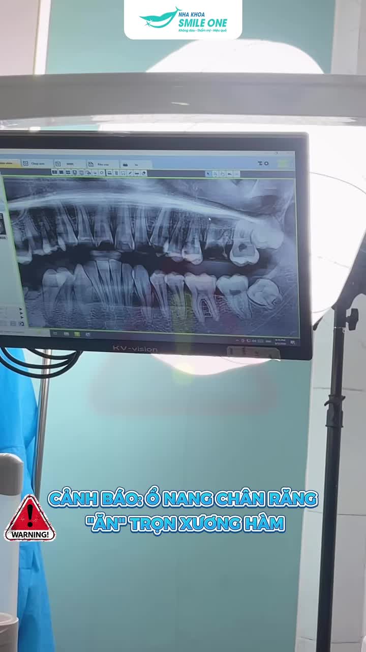 RĂNG VIÊM NANG CHÂN RĂNG NẶNG – CÓ THỂ NHỔ CẤY IMPLANT NGAY?