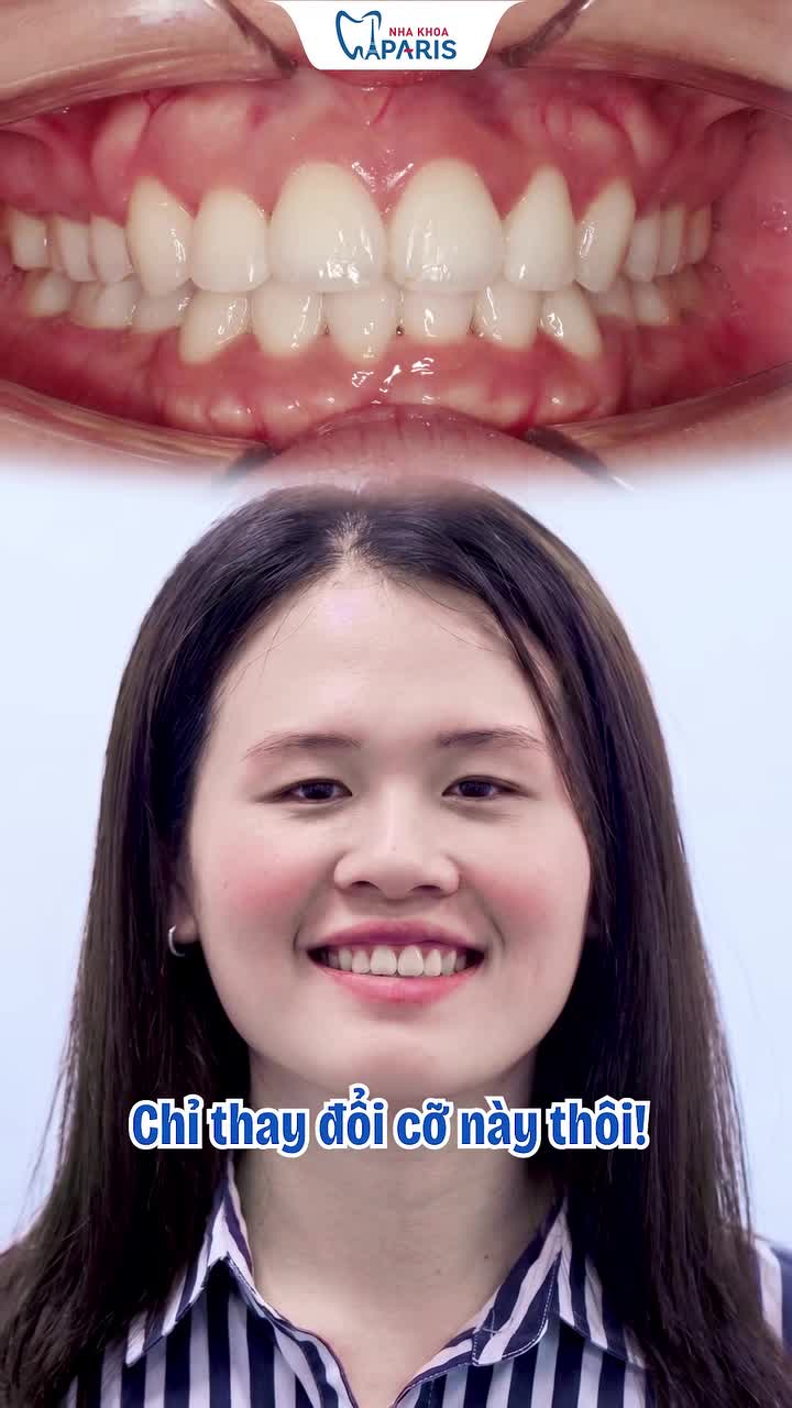 30 TUỔI NIỀNG RĂNG THAY ĐỔI CỠ NÀO?