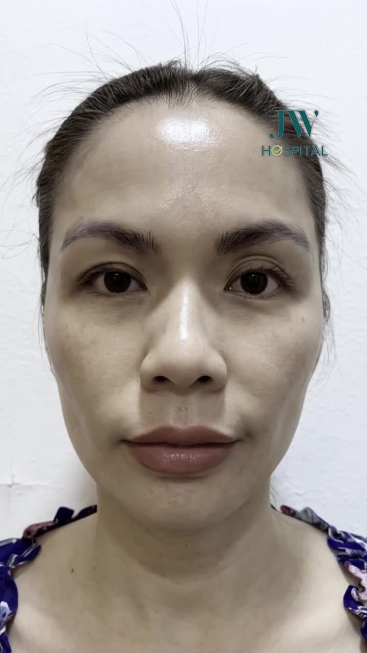 BÁC SĨ TÚ DUNG CẤY M.Ỡ BABY FACE TOÀN MẶT CHO HOTGIRL SÀI GÒN HẾT HỐC HÁC, DIỆN MẠO TƯƠI TRẺ CHỈ SAU 60 PHÚT