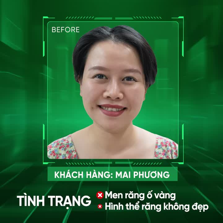 HÀI LÒNG TUYỆT ĐỐI SAU KHI THẨM MỸ RĂNG TẠI NHA KHOA GIA ĐÌNH