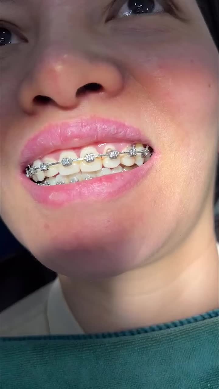 U40 VẪN CÓ THỂ SỞ HỮU HÀM RĂNG ĐỀU ĐẸP - CÙNG CHỊ THÚY AN THÁO MẮC CÀI!