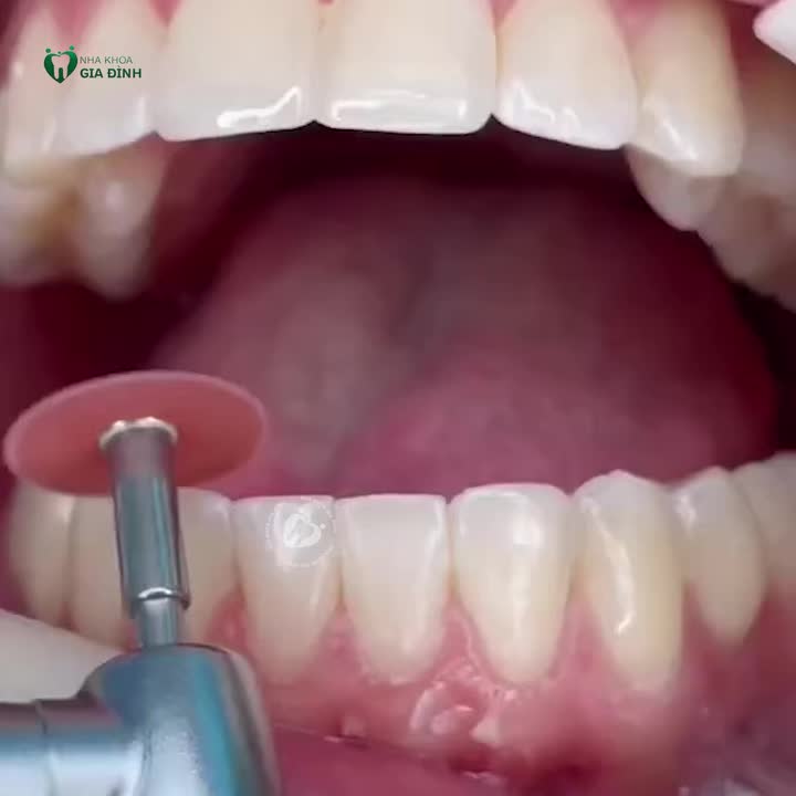 NẾU BẠN ĐANG PHÂN VÂN KHÔNG BIẾT CÓ NÊN NIỀNG RĂNG KHÔNG THÌ HÃY XEM VIDEO NÀY NHÉ!