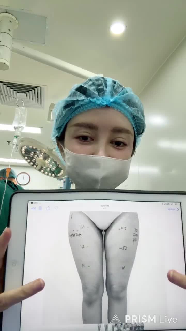 MỘT CA HÚT MỠ ĐÙI, KẾT HỢP CẤY MỠ NGỰC TỰ THÂN!