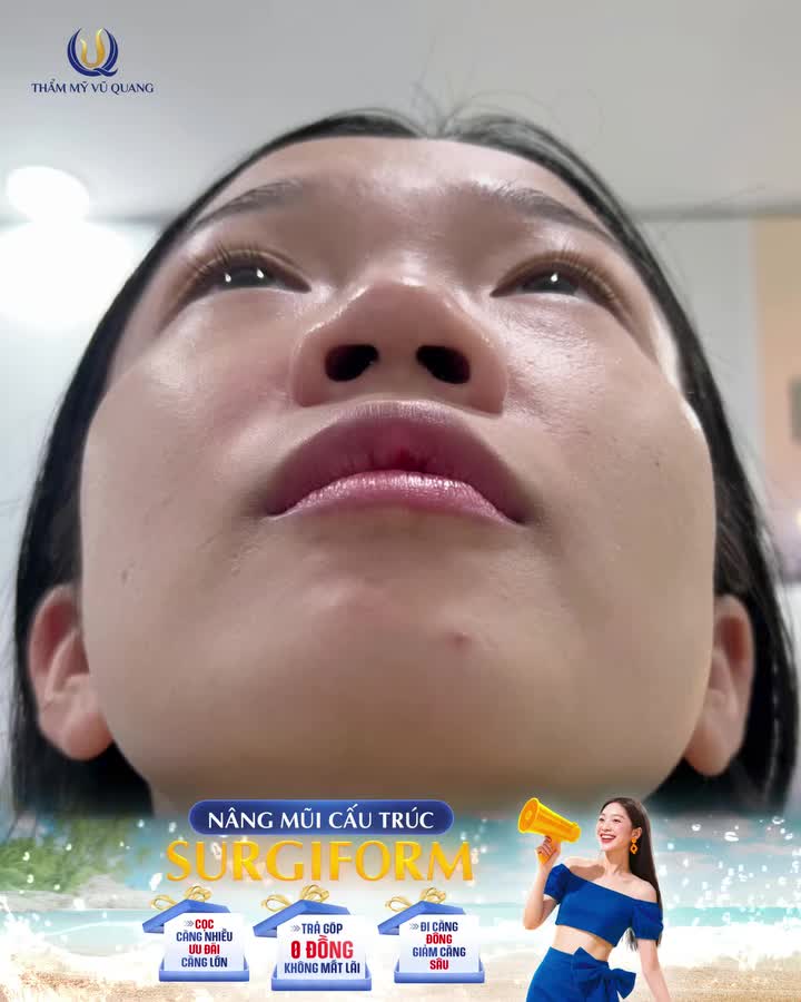 Chìa khóa cho chiếc mũi thanh tú, chuẩn tỷ lệ vàng của hot girl Hạnh Đậu Đậu chính là công nghệ Nâng mũi cấu trúc Surgiform – an toàn, bền đẹp và tự nhiên như thật.