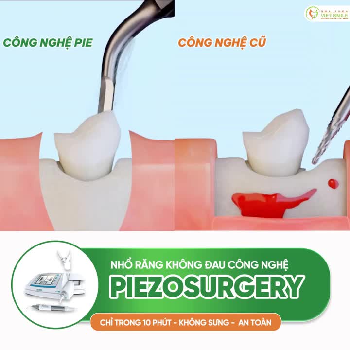 Đừng để chiếc răng khôn "hành" bạn cả tuần chỉ vì chọn nhổ theo cách cũ!
